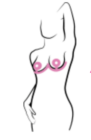 GELSKIN™ anchor shape for breasts - Scar gel sheet